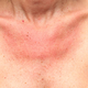 Simptomi alergije na sonce, ki jih ne smete spregledati