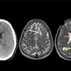 NEOBIČAJEN VZROK POGOSTIH MIGREN: Ličinke svinjske trakulje v možganih (FOTO)