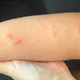 Kje je razlog za širjenje impetiga v Dalmaciji?