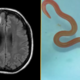 Prvi primer na svetu: v možganih ženske našli živega 8-centimetrskega črva