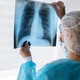 Misteriozni “sindrom belih pljuč” potrjen tudi v Evropi