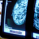 Umetna inteligenca odkrila raka dojke, ki so ga zdravniki spregledali