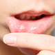 Razlogi, zakaj nastanejo afte in kako se jih znebiti