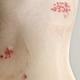 Herpes zoster: Tveganje za okužbo se s starostjo povečuje