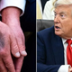 79-letni Trump zanikal slabšanje zdravja; pravi, da ima modrice na rokah, ker jemlje preveč aspirina