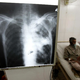 Ukrajinska kriza prinaša nov izziv za obvladovanje tuberkoloze v Sloveniji