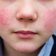 Peta bolezen: starši značilen rdeč izpuščaj nemalokrat zamenjajo z alergijo