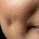Bizaren trend lepotnih operacij: smejalne jamice v licih