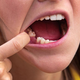 Že en izpadel zob lahko povzroči hude težave
