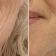 Botoks, polnila, skinbooster ali biostimulator? Razlike, ki jih je dobro poznati.