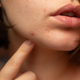 Navade, ki neopazno škodujejo vaši koži bolj, kot si mislite
