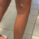 Priljubljena igrača eksplodirala in opekla najstnico, mama zgrožena objavila fotografije (FOTO)