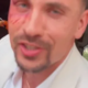 Žan Serčič šokiral z modrico na očesu: kaj se je zgodilo priljubljenemu pevcu?