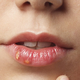 Herpes na ustnicah: Kako ga najhitreje umiriti