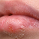 Lahko dobite herpes, če pijete iz tujega kozarca? Odgovor ni tako preprost