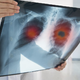 Novo zdravilo za pljučnega raka naj bi zmanjšalo tveganje smrti za polovico