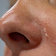 Zakaj se pojavi suha koža okoli nosu?