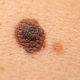 5 znakov melanoma