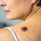 Melanom: dermatovenerologa o prepoznavanju sumljivih znamenj in zaščiti pred soncem