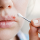 Vas skrbi herpes? Nova dognanja o vplivu virusa na možganske celice