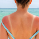 Vas je opeklo? Dermatologi razkrivajo, kaj koža po opeklini najbolj potrebuje