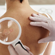 Dermatologinja opozorila na šest znakov raka kože, ki jih običajno zanemarimo
