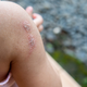 Impetigo na pohodu: Zakaj se ta zelo nalezljiva kožna okužba poleti tako hitro širi?