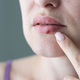 Herpes: Zato se pri nekaterih pojavlja pri drugih pa ne
